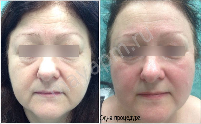 Reports On Accutane